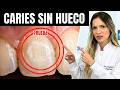 La Caries No Duele Al Inicio: Cuando Duele, Ya Llegaste Tarde