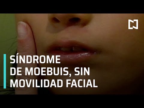 Video: ¿Se puede curar el síndrome de Moebius?