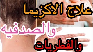 علاج الاكزيما والصدفيه والقضاء علي الفطريات بالمنزل