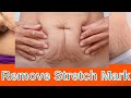 How to fade stretch marks tips and tricks for smooth skin