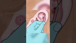 Asmr Ear Blackhead Removal Animation
