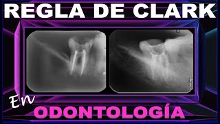 INDICACIONES PARA LA REGLA O TÉCNICA RADIOGRÁFICA  DE CLARK EN ODONTOLOGÍA