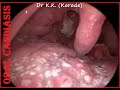 Video Laryngoscopy : Oral Thrush / Oral Candiasis (Fungal infection) in Adult