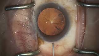 25.05.01 M.63 Od Eyhance 78252