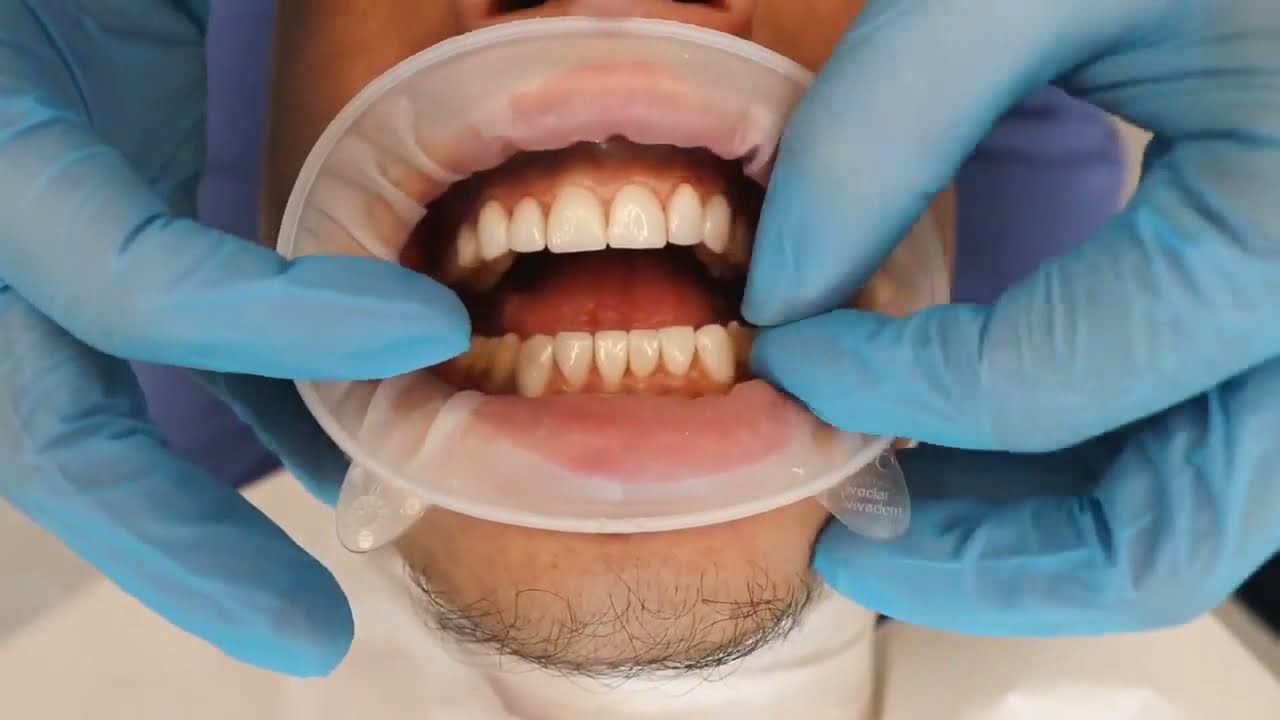 Digital Smile Design: Creating Your Perfect Smile