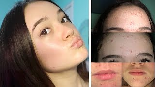 My Everyday Skincare Routine (Acne to Clear Skin) ... FionaFrills Vlogs