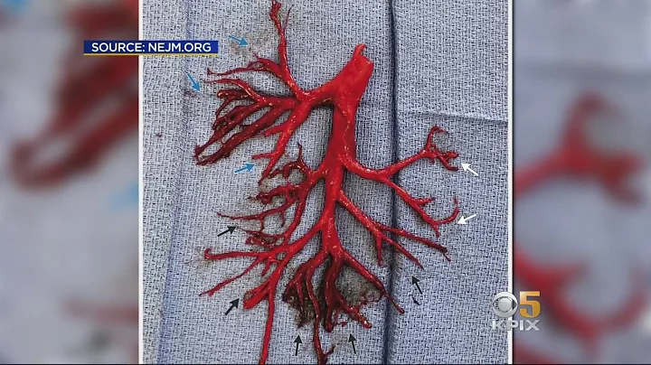 Man Coughs Up 6-Inch Blood Clot in Shape of a Bronchial Tree, Dies - DayDayNews