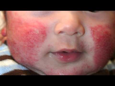 Видео: Атопичен дерматит при възрастни и деца - причини, симптоми, диета и лечение на атопичен дерматит с народни средства