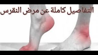 النقرس و ألامه