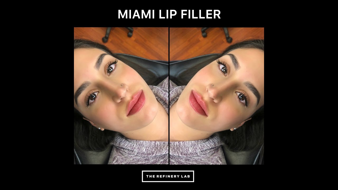Best Lip Injections in Miami! Miami Lip Fillers YouTube