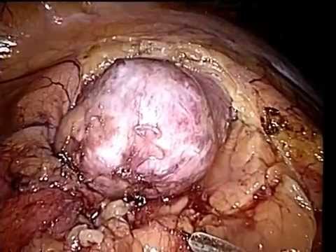 Right Laparoscopic Partial Nephrectomy 1