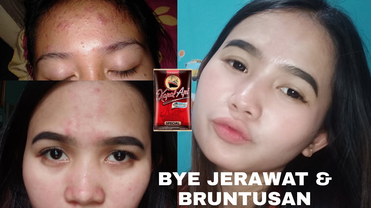 View Cara Menghilangkan Jerawat Bruntusan PNG