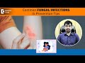 ITCHY SKIN &amp; HAIR?- Prevent &amp; Treat Common FUNGAL INFECTIONS - Dr.Rajdeep Mysore | Doctors&#39; Circle