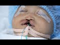 Very Rare Median Cleft Lip - Complete Surgery & Recovery