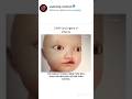 Cleft lip 👄 surgery in infant 👶 #trending #viral #doctorlife #anatomy #shortvideo #surgeryreels