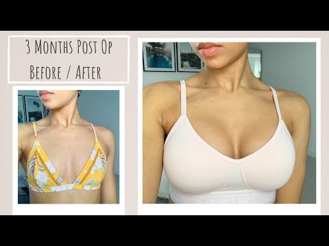 I got a BOOB JOB *Vlog* my experience, cost + 3 month updates