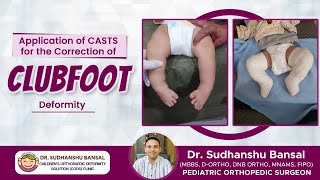 Clubfoot Deformities Casting Technique for parents reference | Dr Sudhanshu Bansal