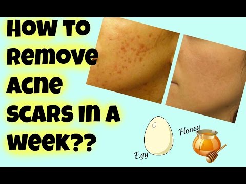 How to remove Acne Scars in a week ?? || Egg White Mask