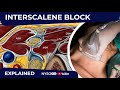 US-Guided Interscalene Brachial Plexus Block - Regional anesthesia Crash course with Dr. Hadzic