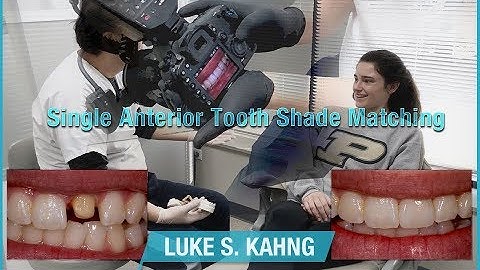 Single Anterior Tooth Shade Matching
