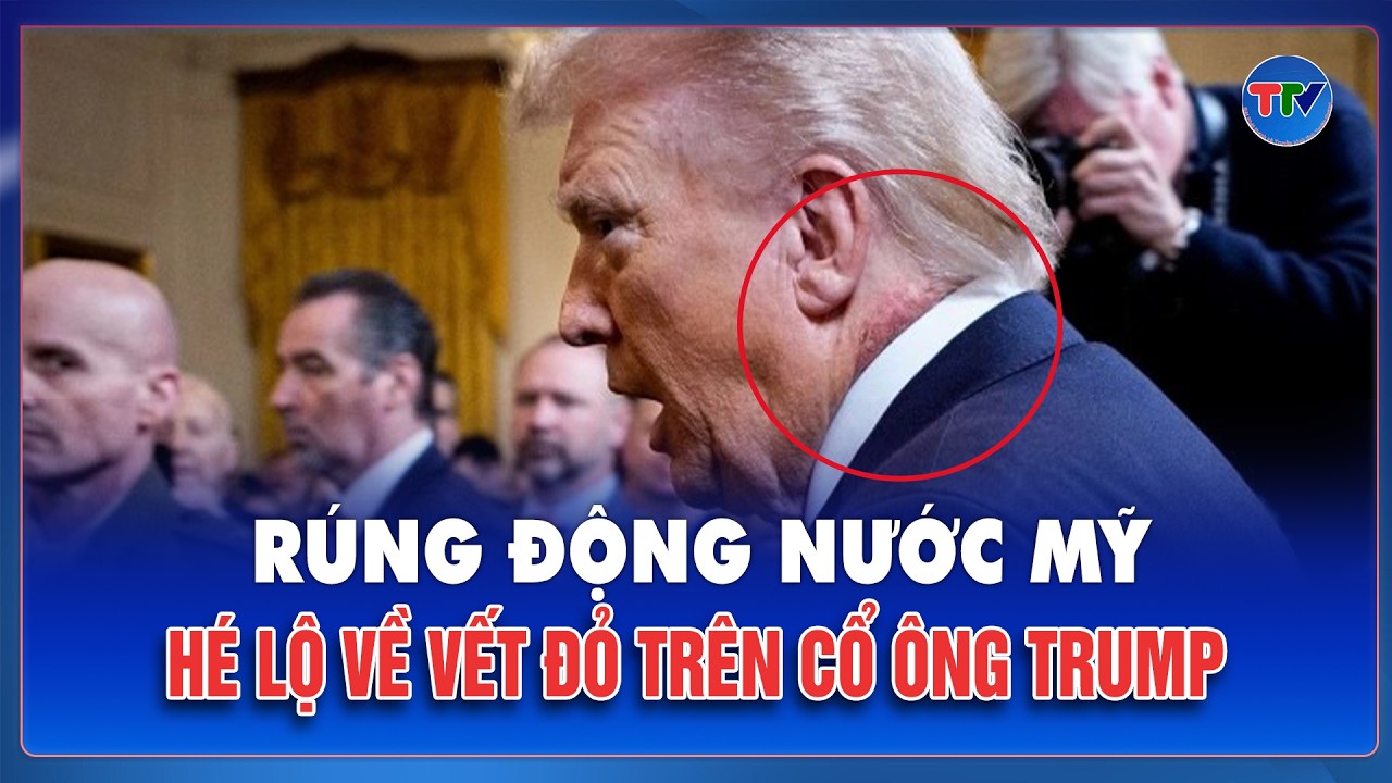 Cận cảnh vết đỏ trên cổ ông Trump: Sự cố nhỏ hay dấu hiệu bất thường?