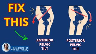 Anterior Pelvic Tilt Fix for Back Pain Relief | Exercise