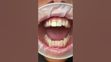 8 Upper Composite Veneers #shorts