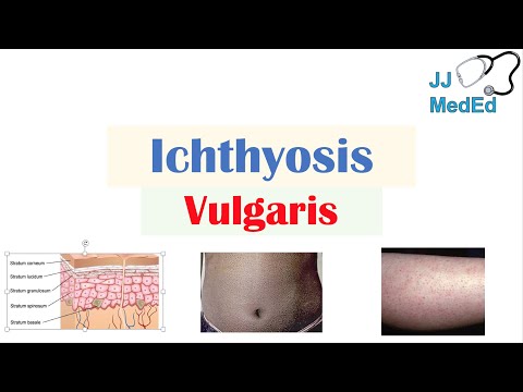 Video: Ichthyosis Vulgaris Dan Diet: Adakah Terdapat Sambungan?