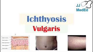 Ichthyosis Vulgaris | Causes, Signs & Symptoms, Diagnosis, Treatment