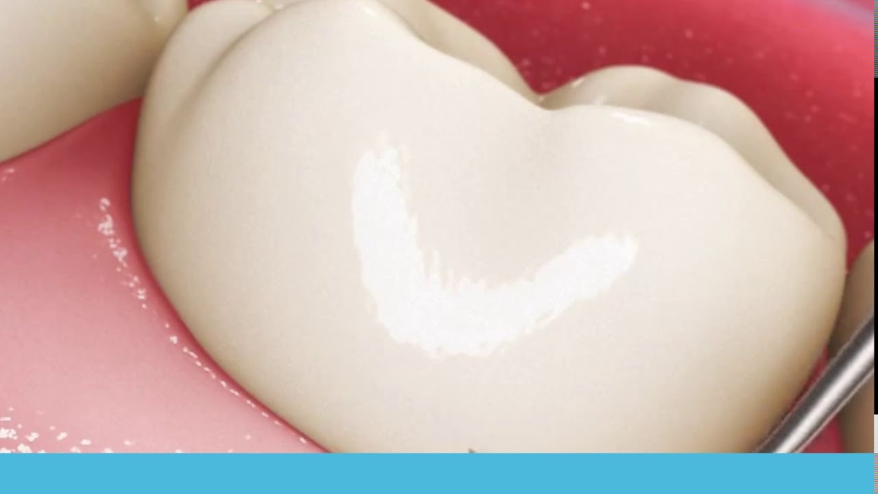 ORALY Ultrasonic Tooth Cleaner NEXT GENERATION™ YouTube