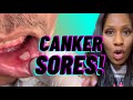 What Causes Canker Sores? What’s the Best Treatment? How to Get Rid of a Canker Sore Fast?