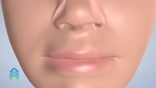 Cleft Lip Treatment At Avon Oral, Facial And Dental Implant Surgery , Avon, Ct