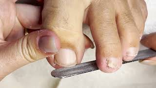 Ingrown Toenail Pain Fixed