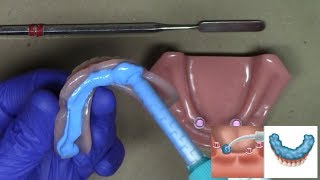 Laboratory Reline for LOCATOR and LOCATOR R-Tx Dentures: Step-By-Step Technique screenshot 3