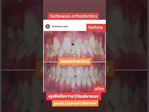 ορθοδοντική fastbraces πριν