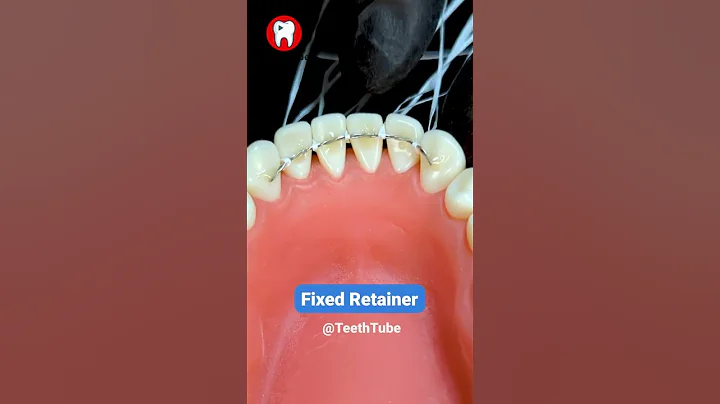 Fixed Retainer #shorts - DayDayNews