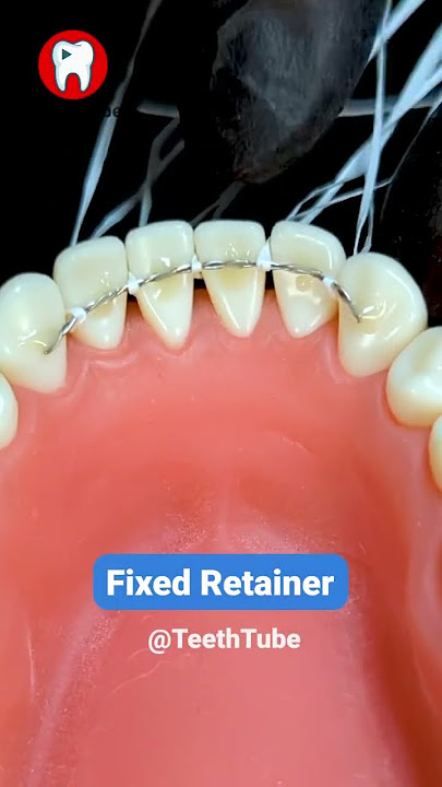 Fixed Retainer #shorts