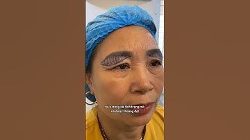 Sụp mí mắt và biến chứng nguy hiểm bạn cần biết | Bác Sỹ Tuấn Dương #shorts