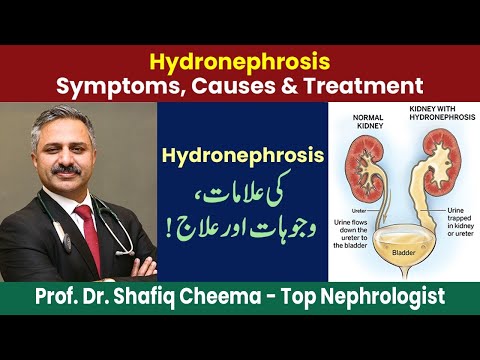 Hydronephrosis Symptoms, Causes & Treatment