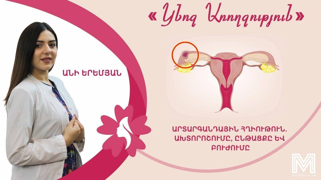 Արտարգանդային հղիութուն   Ախտորոշումը, ընթացքը և բուժումը․ «Կնոջ Առողջություն»