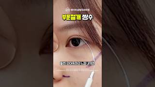 부분절개 쌍꺼풀수술 후기 #shorts