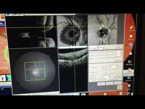 Eye Tissue Segmentation technology  :Best Eye hospital