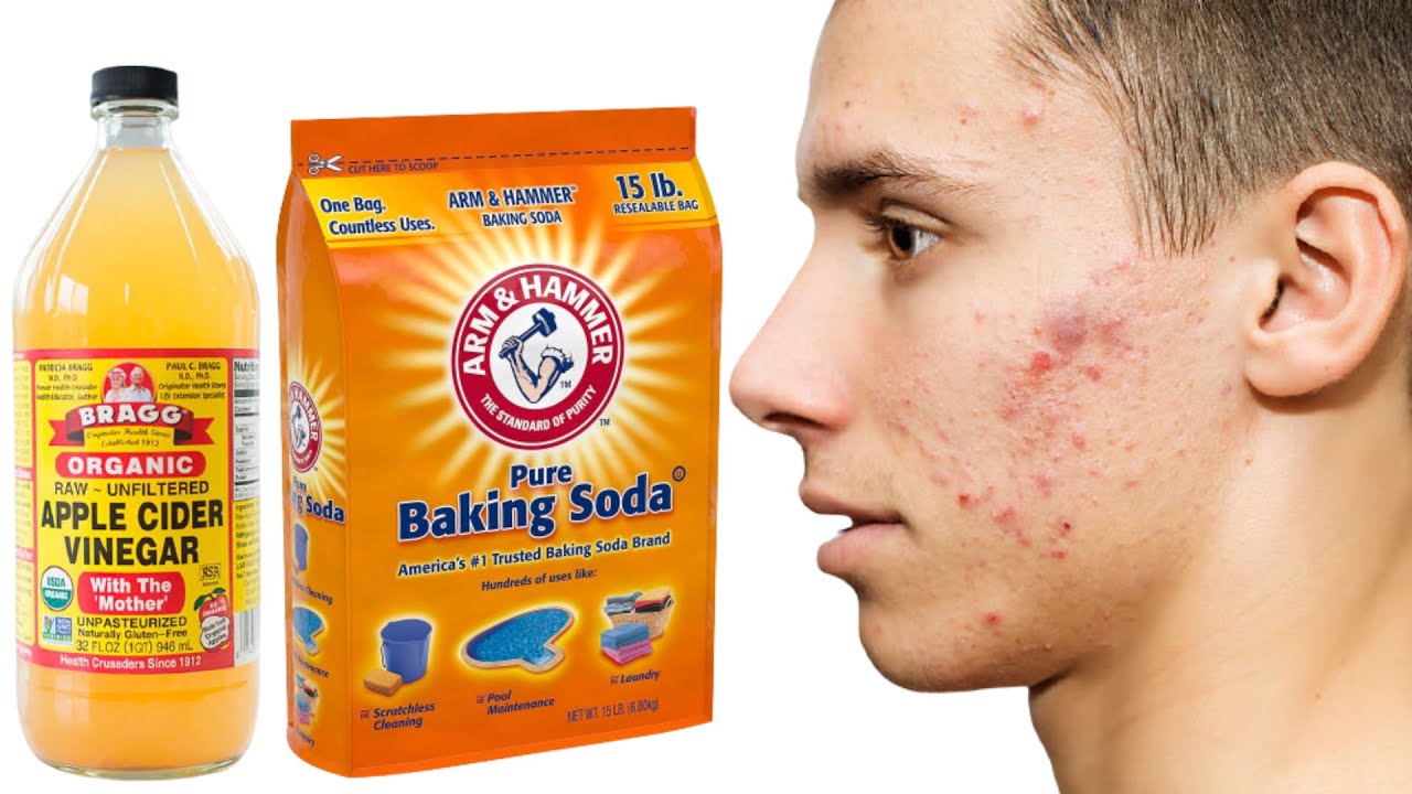 How To Use Apple Cider Vinegar And Baking Soda For Acne And Pimples