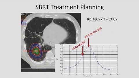 MedPhys - 22.2 - Stereotactic Treatments: Stereotactic Body Radiation Therapy (SBRT).