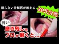 歯磨きで汚い磨き残しがあると歯周病は治りません。プロが磨くとこうなります。歯周病リスクを下げ、虫歯を予防するためには歯磨き上手になりましょう。