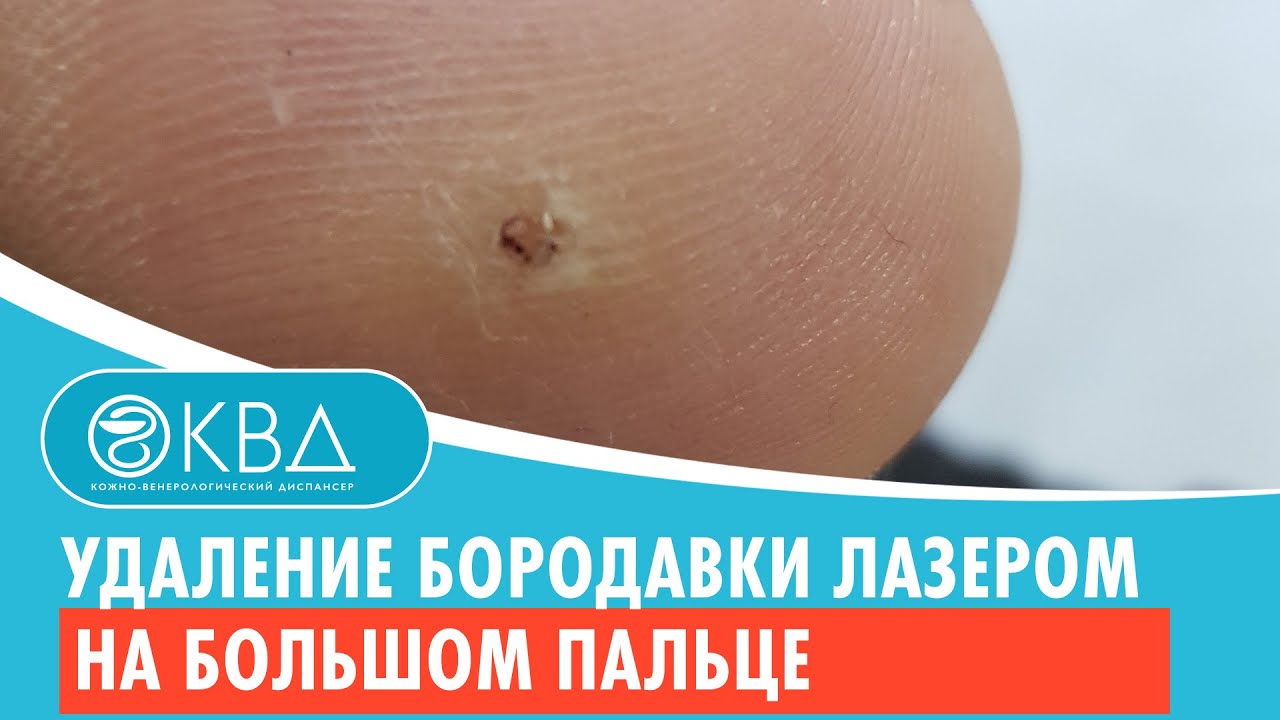 Удаление бородавки лазером на большом пальце. Клинический случай №515 ...