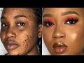 HOW TO COVER ACNE DARK SPOTS /MARKS & HYPERPIGMENTATION | FOUNDATION ROUTINE for hyperpigmentation