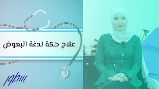 علاج حكة لدغة البعوض