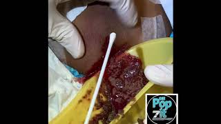 HUGE INFLAMED CYST/ABSCESS POP. Squirts over 3 feet. Cyst squirt. Cyst explosion. MrPopZit