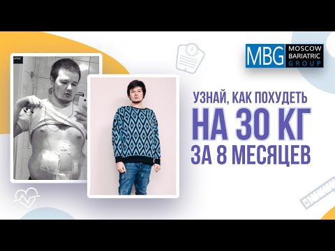 Минус 30 кг за 8 месяцев | Отзыв пациента после операции Бандажирование желудка